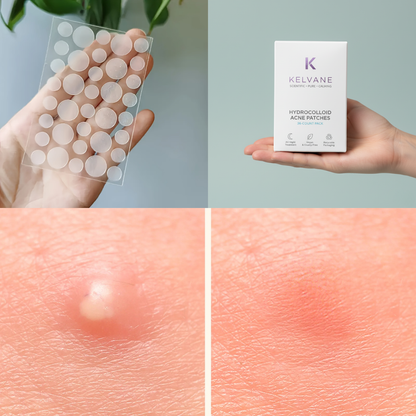 Επικολλήσεις Αντι-Ακνής - 36 τεμάχια σε 2 Μεγέθη - Τεχνολογία Υδροκολλοειδούς